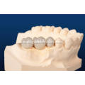 zirconia porcelain fused ກັບເຮືອນຍອດໂລຫະ